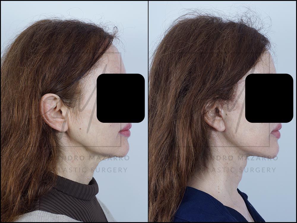 3-month result of preservation deep plane facelift and necklift in a 59-year-old woman, right straight profile showing rejuvenated facial contour and defined neck. Performed by Dr. Mazarro.