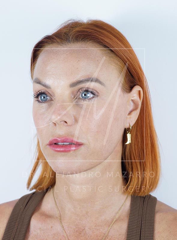 8-month result of a Preservation Deep Plane Facelift in a 47-year-old patient, no pulled look and defined contour. Performed by Dr. Mazarro.