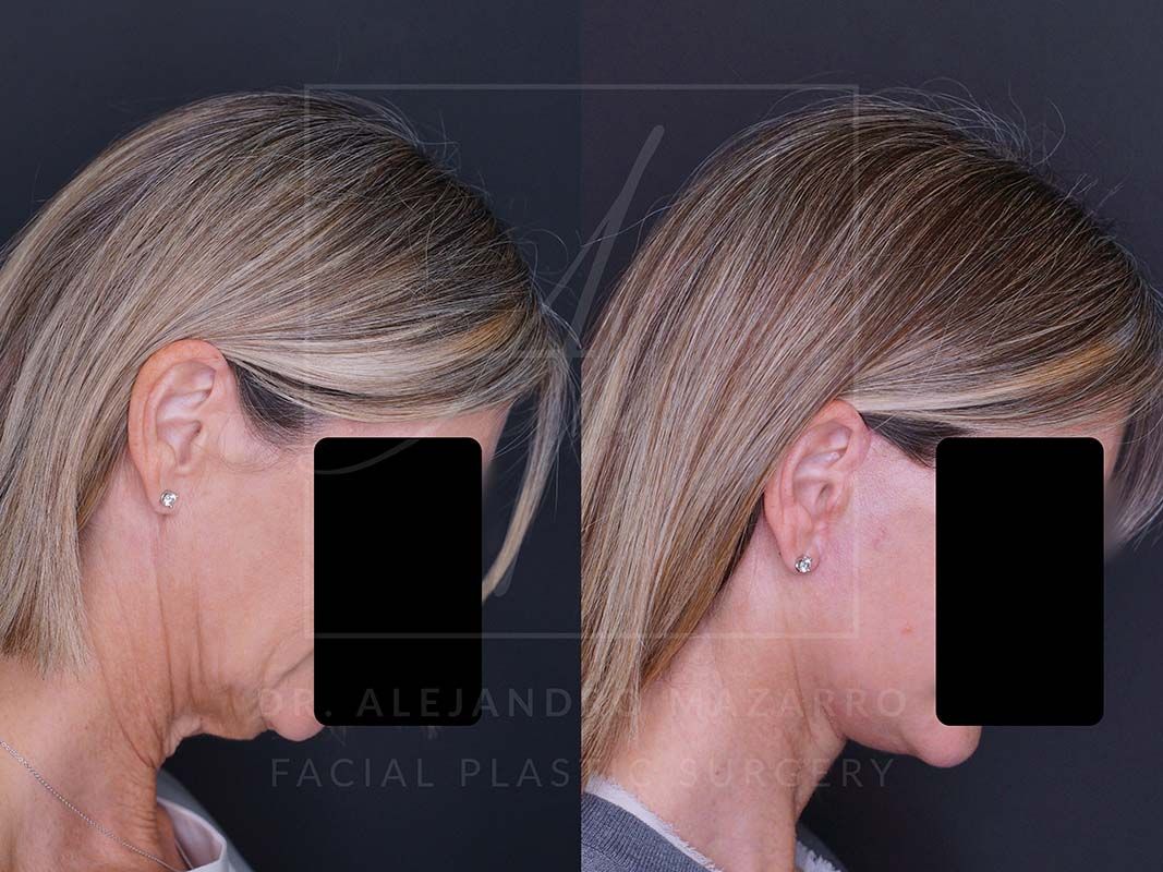 Preservation  Deep Plane Facelift- Dr. Mazarro