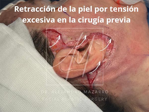Retracción de la piel por tensión excesiva en la cirugía previa