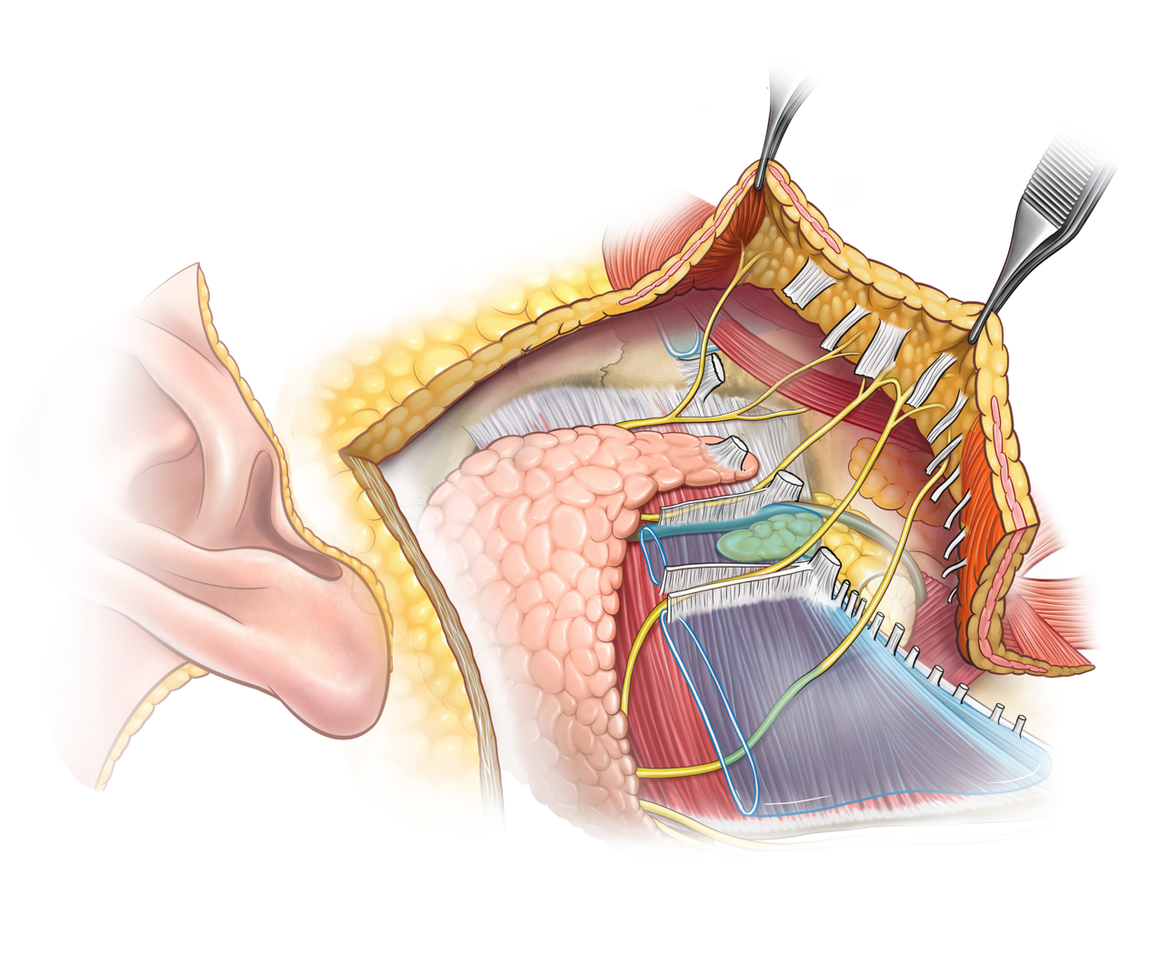 Relación del nervio facial con la musculatura en un lifting Deep Plane