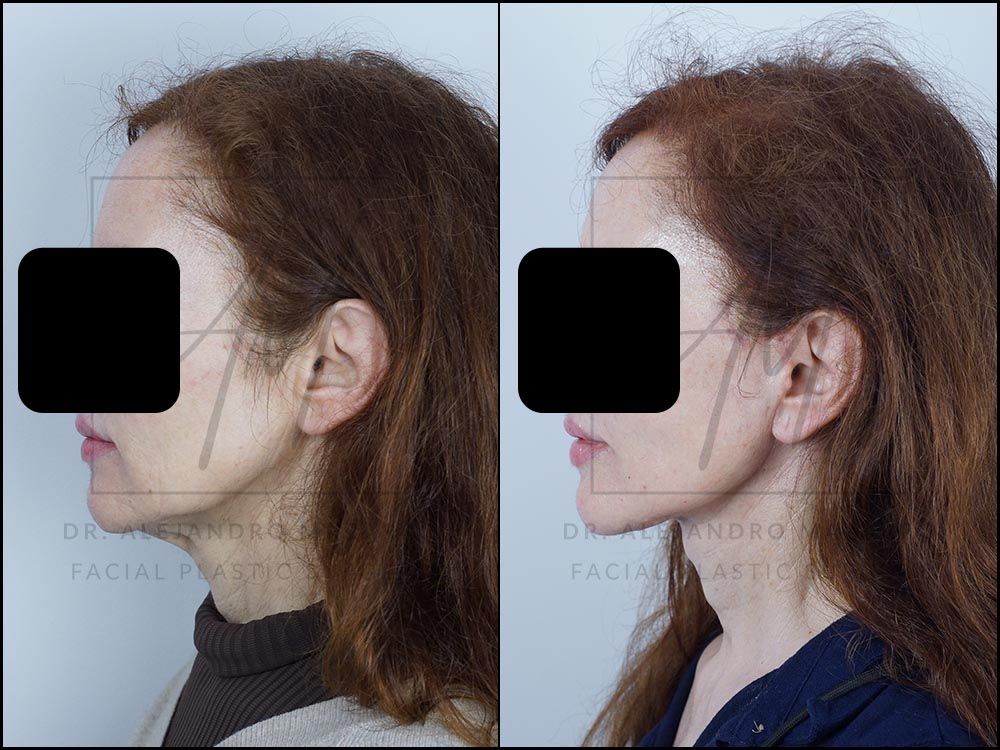 Pacient dona 59 anys - Vista de perfil esquerre abans i després de Lifting Cervicofacial Deep Plane de Preservació a 3 mesos pel Dr. Alejandro Mazarro a Barcelona.