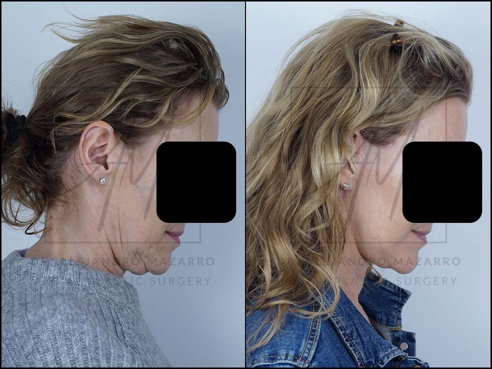 Preservation  Deep Plane Facelift- Dr. Mazarro