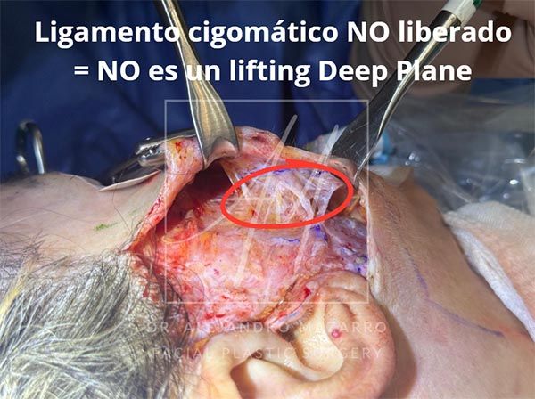 Falso lifting Deep Plane - Ligamento cigomático sin liberar