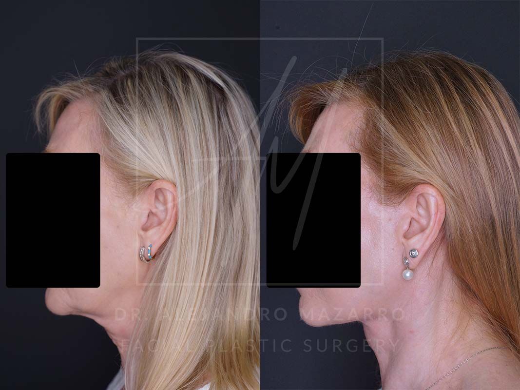 Preservation  Deep Plane Facelift- Dr. Mazarro