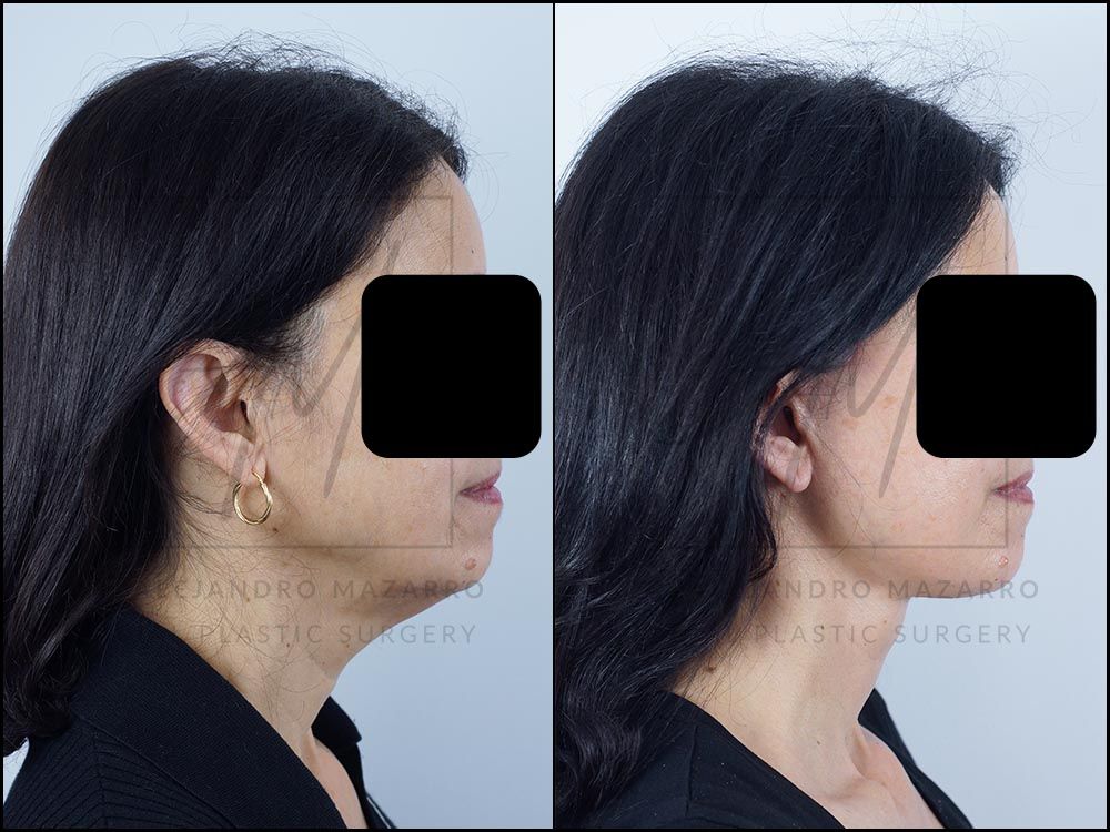 Resultado a los 8 meses de lifting deep plane de preservación y deep neck lift en mujer de 56 años, perfil derecho con contorno facial armonioso y cuello rejuvenecido. Realizado por el Dr. Mazarro.