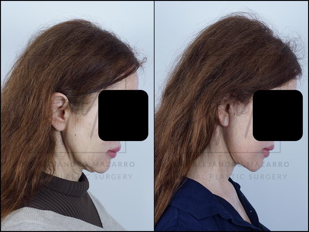 Pacient dona 59 anys - Vista de perfil dret amb mentó cap avall abans i després de Lifting Cervicofacial Deep Plane de Preservació a 3 mesos pel Dr. Alejandro Mazarro a Barcelona.