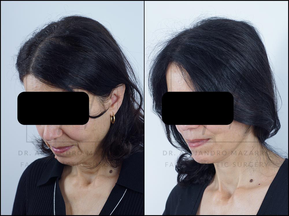Resultado a los 8 meses de lifting deep plane de preservación y deep neck lift en mujer de 56 años, vista 3/4 con mentón hacia abajo mostrando la elegancia y definición del cuello. Realizado por el Dr. Mazarro.