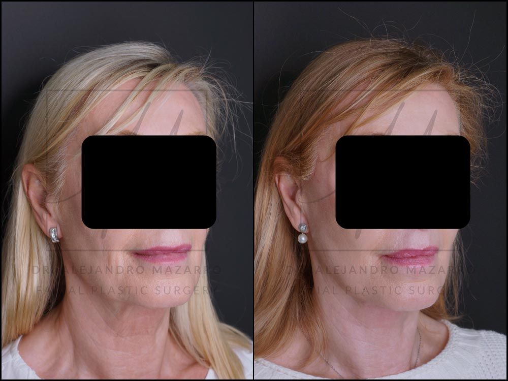 5-month result of preservation deep plane facelift and deep neck lift in a 65-year-old woman, right 3/4 view showing naturally and elegantly enhanced facial structure. Performed by Dr. Mazarro.