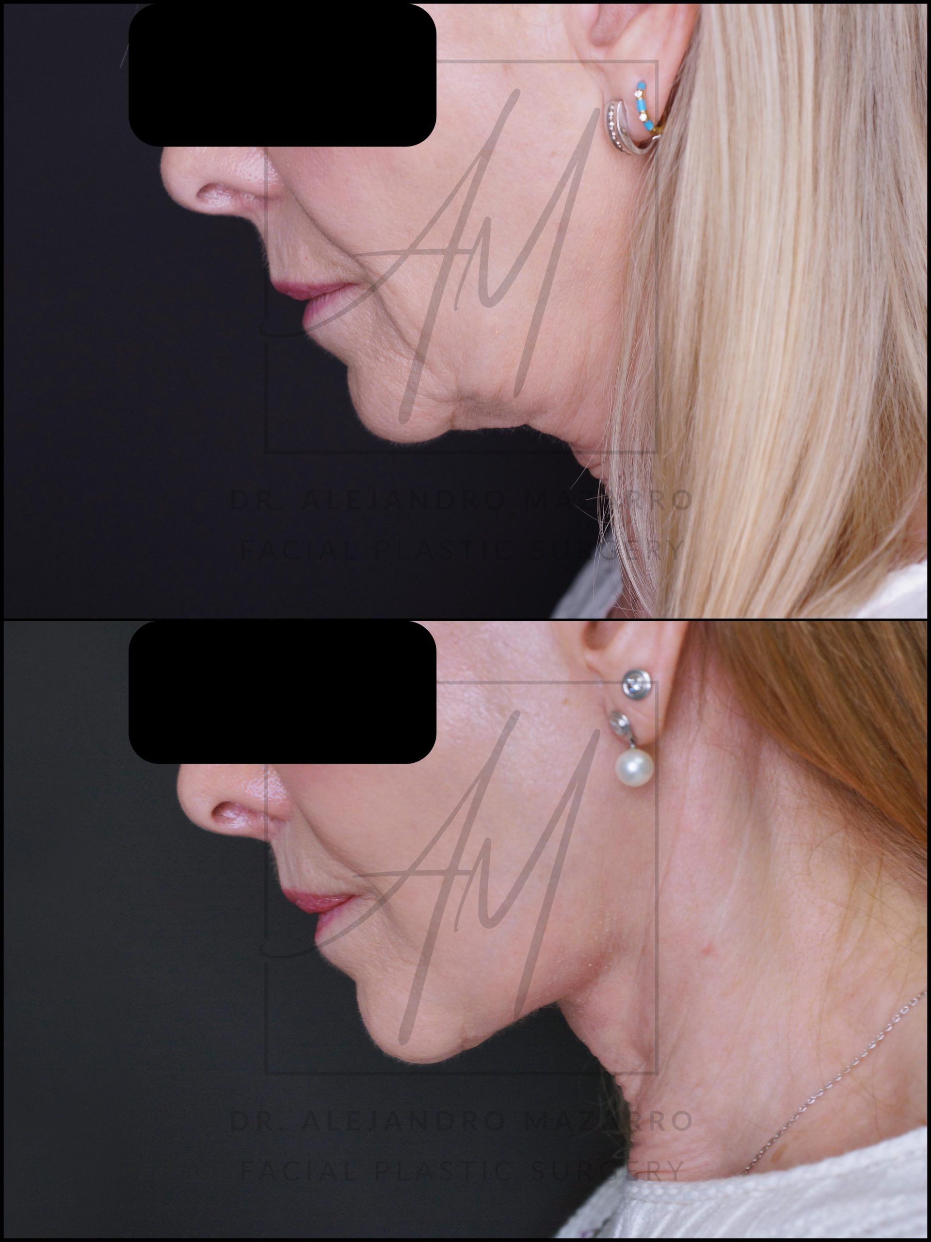 5-month result of preservation deep plane facelift and deep neck lift in a 65-year-old woman, left profile with chin down showing elegant and natural neck and jawline definition. Performed by Dr. Mazarro.