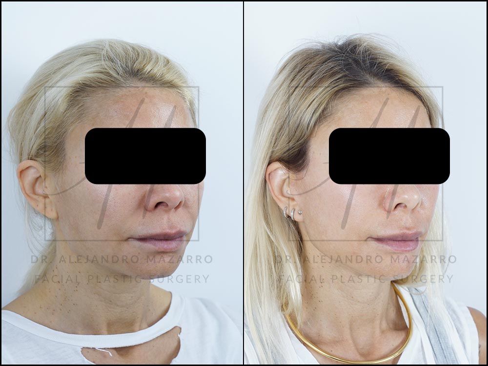 9-month result of preservation deep plane facelift and deep neck lift in a 44-year-old woman, right 3/4 view with rejuvenated facial contour and defined neck. Performed by Dr. Mazarro.