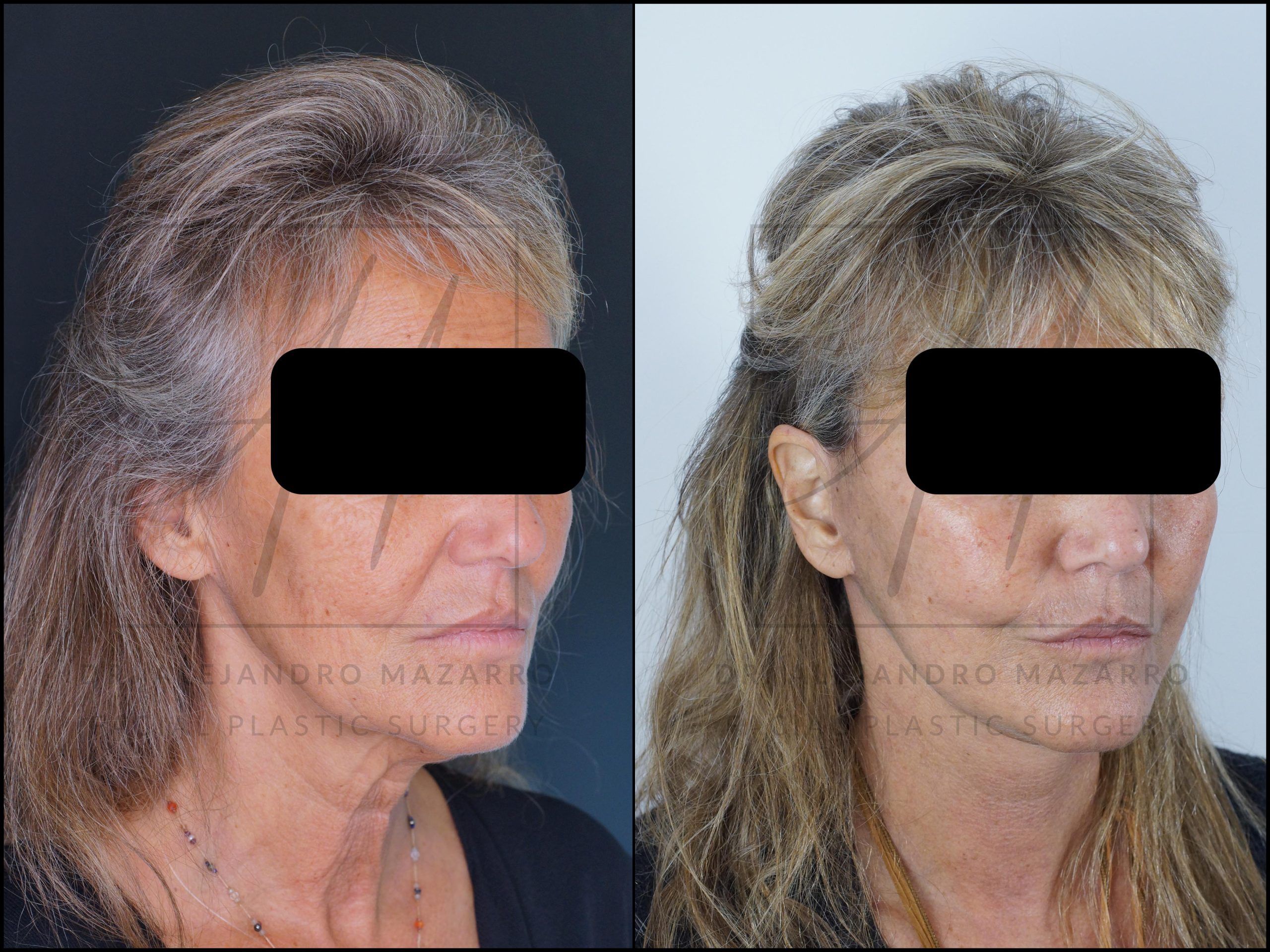 Patiente femme 59 ans - Vue 3/4 droite avant et après un Lifting du Visage et du Cou Deep Plane de Préservation à 5 semaines par le Dr Alejandro Mazarro à Barcelone.
