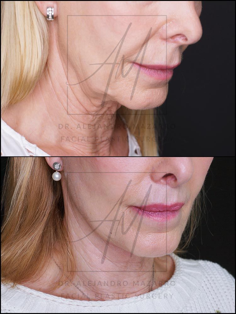 5-month result of preservation deep plane facelift and deep neck lift in a 65-year-old woman, right 3/4 view with chin down showing elegant and natural neck and jawline definition. Performed by Dr. Mazarro.