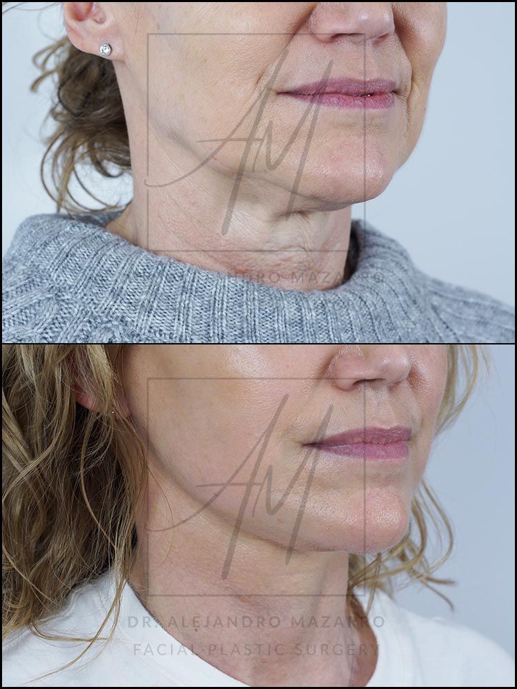 7-week result of preservation facelift in a 55-year-old woman, right 3/4 view with rejuvenated facial contour and defined neck. Performed by Dr. Mazarro.