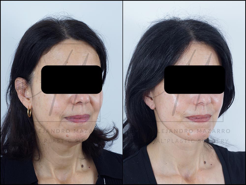 8-month result of preservation deep plane facelift and deep neck lift in a 56-year-old woman, right 3/4 view with defined facial contour and rejuvenated neck. Performed by Dr. Mazarro.