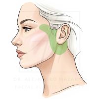 Esquema de lifting de preservacion