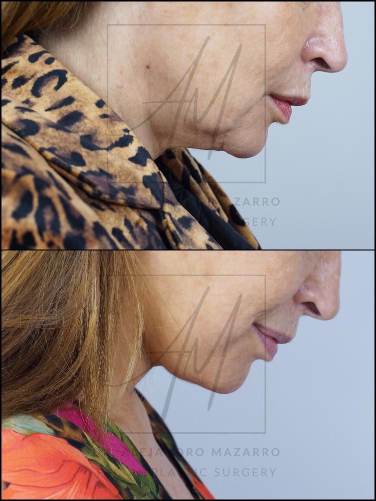 4-month result of preservation deep plane facelift and deep neck lift in a 53-year-old woman, right profile with chin down showing elegant neck and jawline definition. Performed by Dr. Mazarro.