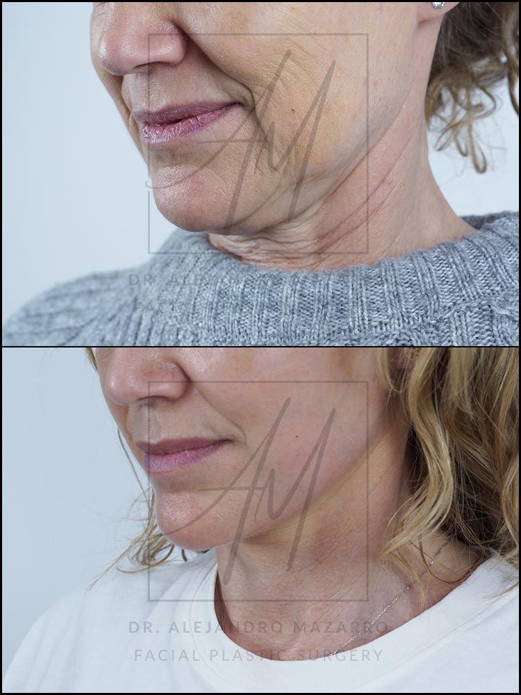 7-week result of preservation facelift in a 55-year-old woman, left 3/4 view with chin down showing the definition and naturalness of the rejuvenated neck. Performed by Dr. Mazarro.