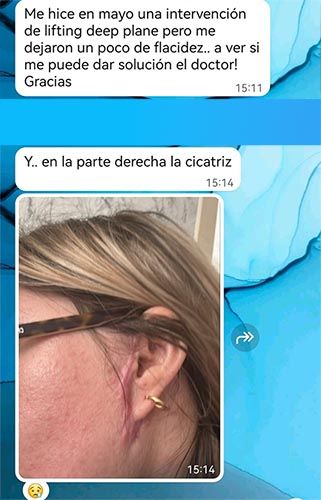 cuidado con el lifting Deep Plane