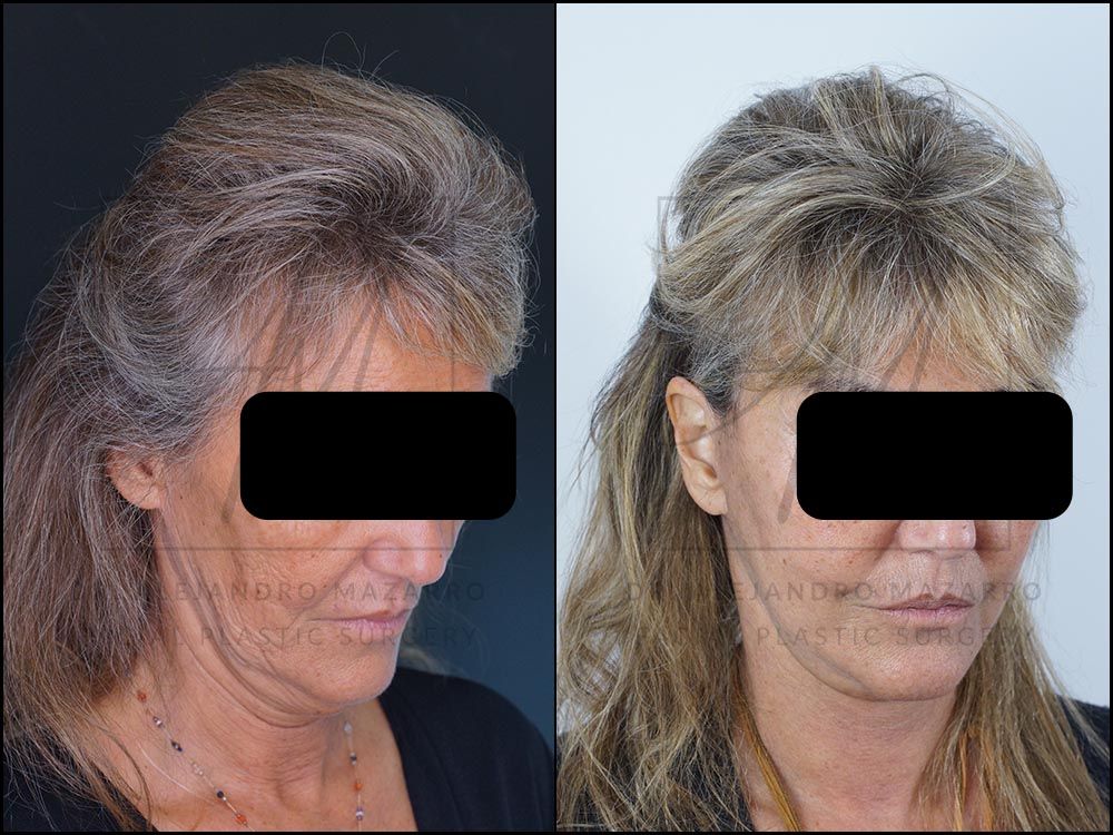 Resultado a las 3 semanas de lifting deep plane de preservación en mujer de 59 años, con cuello rejuvenecido y definición cervical. Realizado por el Dr. Mazarro.