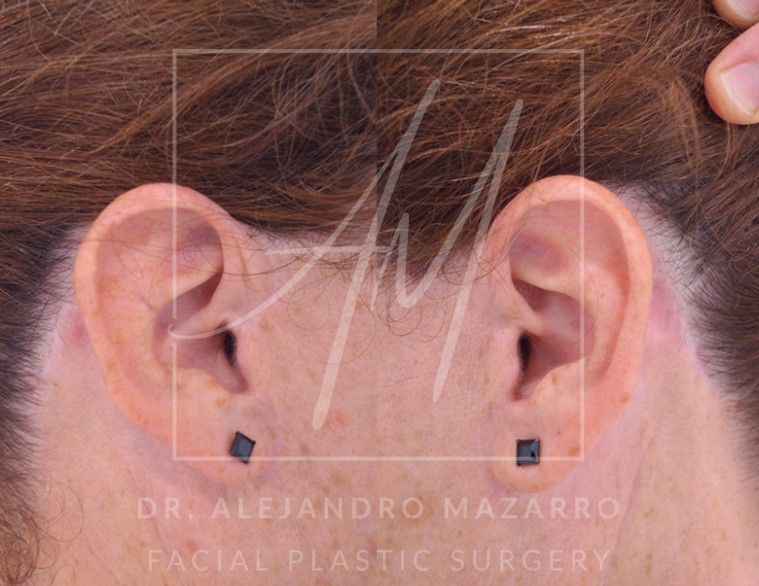 cicatrices lifting Deep Plane - Dr. Mazarro