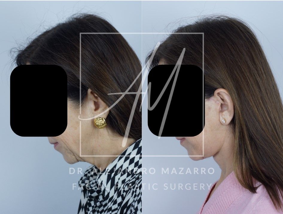 Preservation  Deep Plane Facelift- Dr. Mazarro