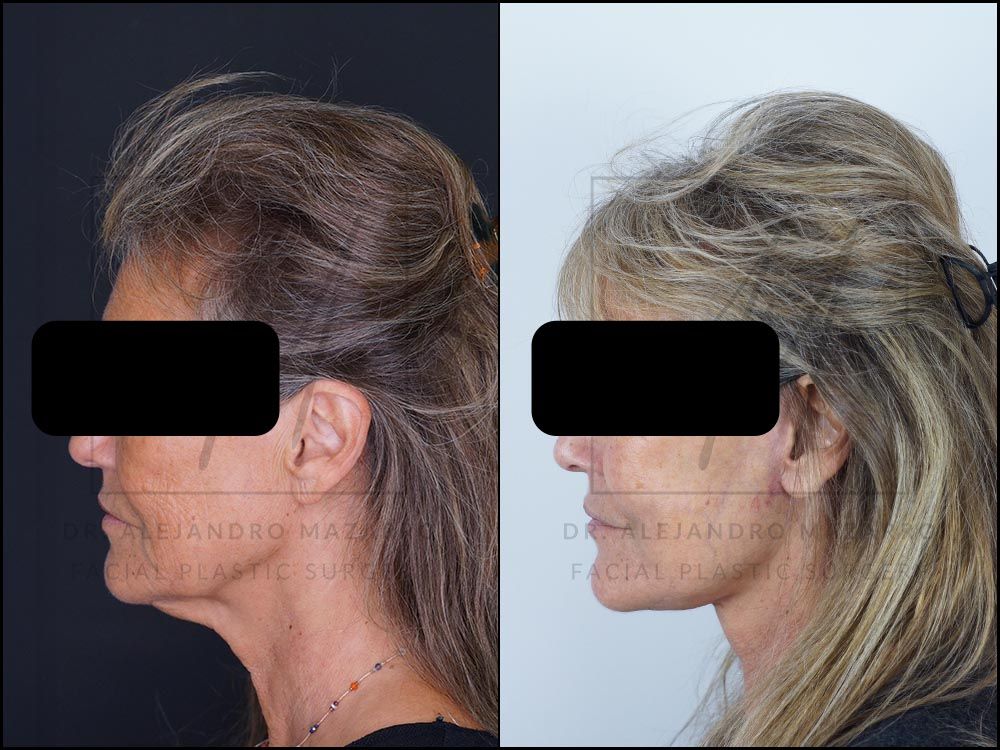 3-week result of a preservation deep plane facelift in a 59-year-old woman, with rejuvenated facial oval and harmonious profile. Performed by Dr. Mazarro.