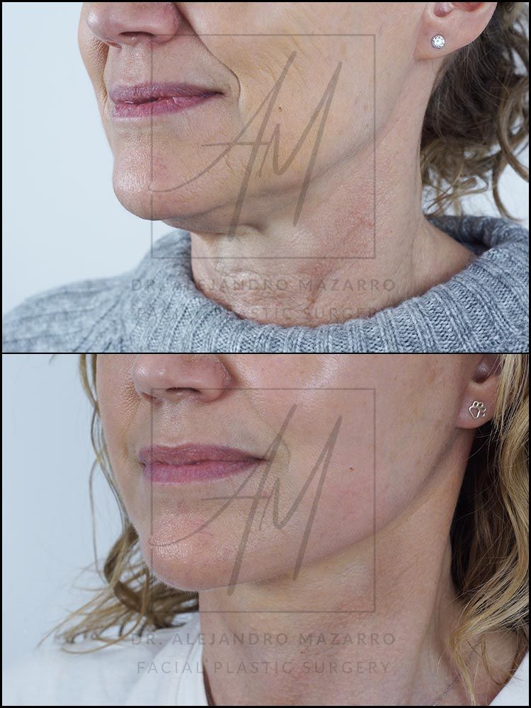 7-week result of preservation facelift in a 55-year-old woman, right 3/4 view with rejuvenated facial contour and defined neck. Performed by Dr. Mazarro.