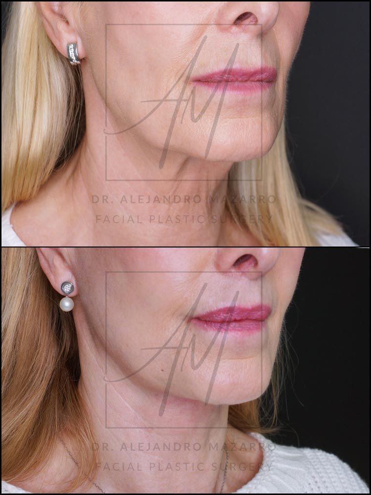 Pacient dona 67 anys - Vista 3/4 dreta abans i després de Lifting Cervicofacial Deep Plane de Preservació a 5 mesos pel Dr. Alejandro Mazarro a Barcelona.