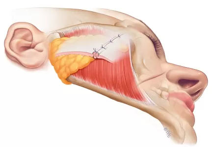 Plicatura de SMAS - Dr. Mazarro