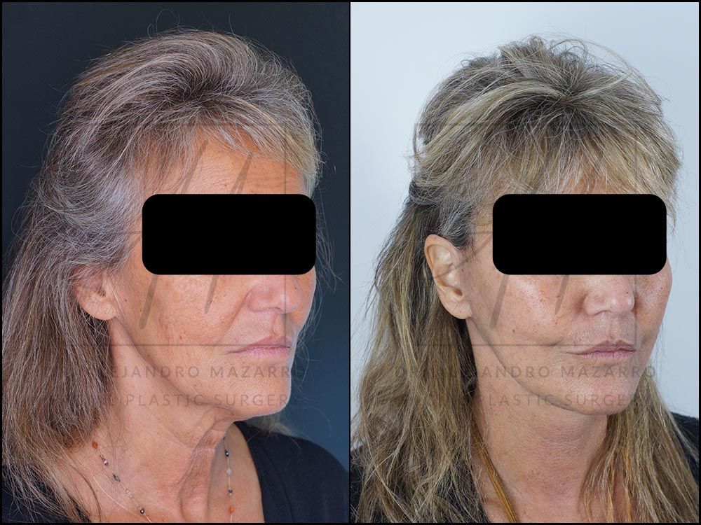Resultado a las 3 semanas de lifting deep plane de preservación en mujer de 59 años, mostrando rejuvenecimiento facial natural y definición del óvalo. Realizado por el Dr. Mazarro.
