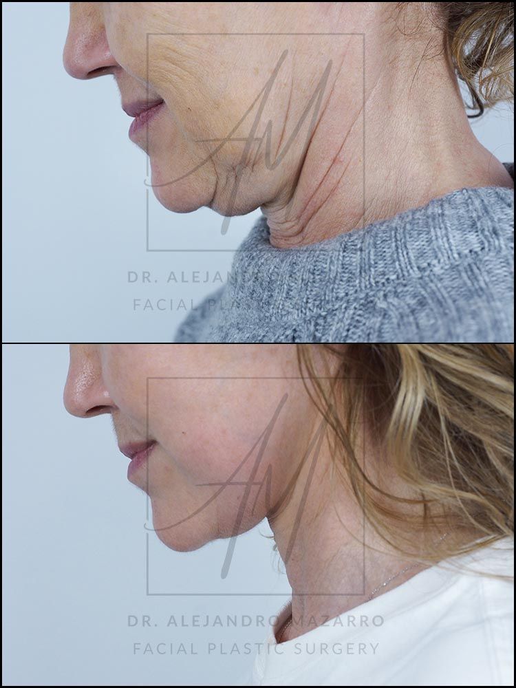 7-week result of preservation facelift in a 55-year-old woman, left profile with chin down showing the definition and naturalness of the rejuvenated neck. Performed by Dr. Mazarro.