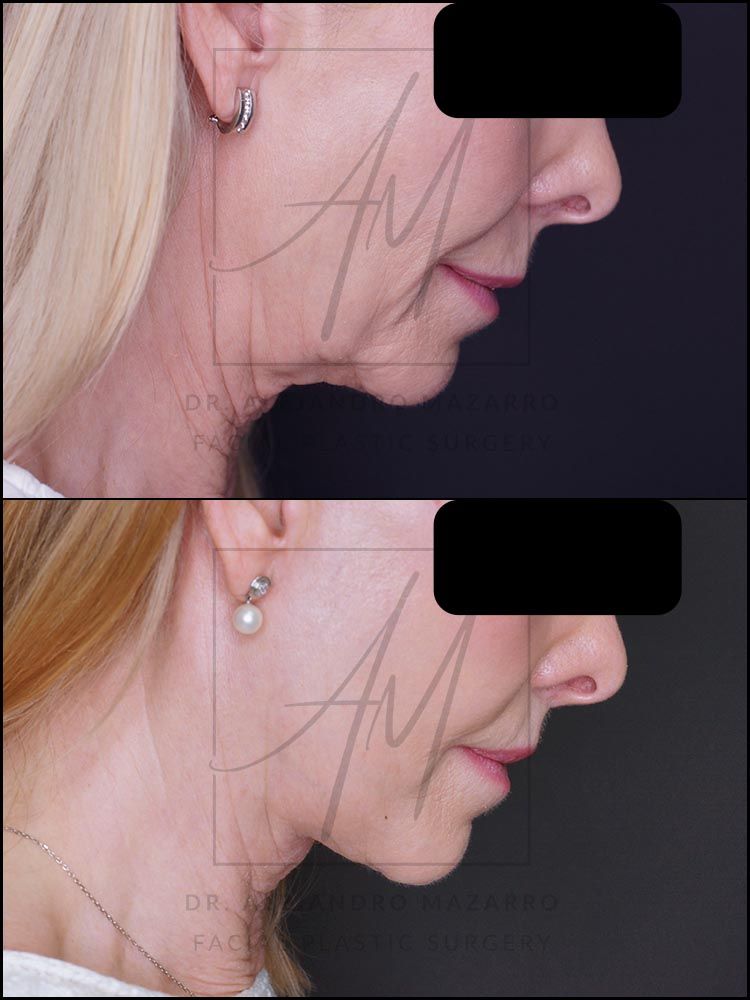 5-month result of preservation deep plane facelift and deep neck lift in a 65-year-old woman, right profile with chin down showing elegant and natural neck and jawline definition. Performed by Dr. Mazarro.