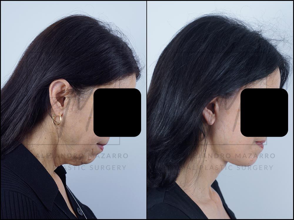 Resultado a los 8 meses de lifting deep plane de preservación y deep neck lift en mujer de 56 años, vista 3/4 con mentón hacia abajo mostrando la elegancia y definición del cuello. Realizado por el Dr. Mazarro.