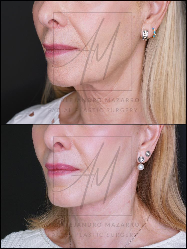 Pacient dona 67 anys - Vista 3/4 esquerra abans i després de Lifting Cervicofacial Deep Plane de Preservació a 5 mesos pel Dr. Alejandro Mazarro a Barcelona