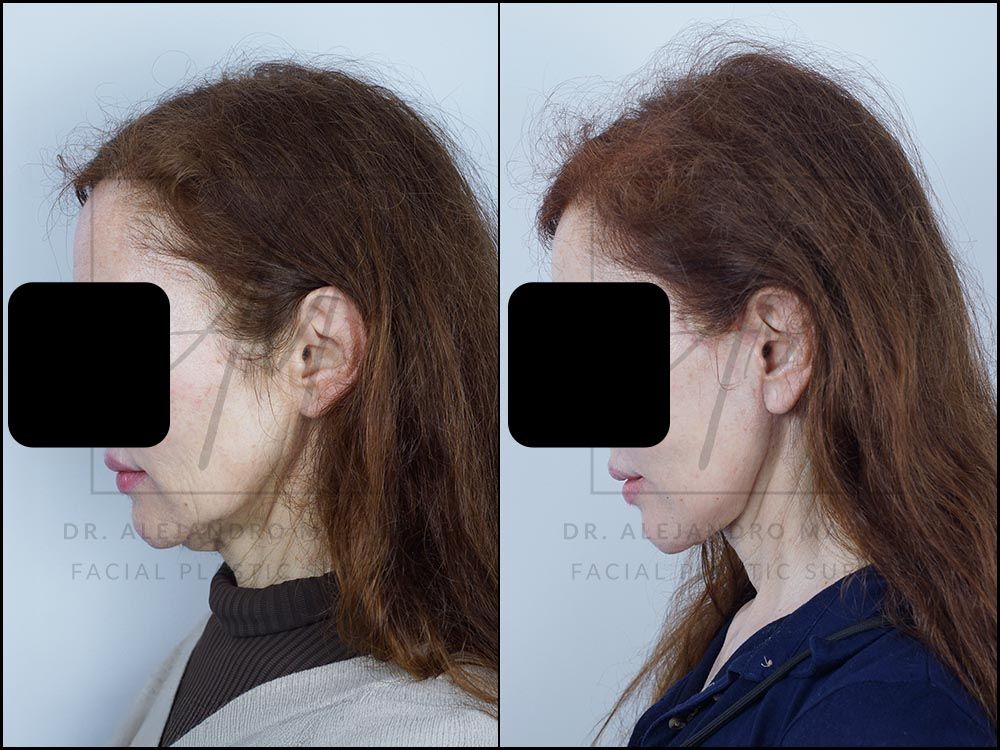 3-month result of preservation deep plane facelift and necklift in a 59-year-old woman, left profile with chin down showing the definition and naturalness of the rejuvenated neck. Performed by Dr. Mazarro.