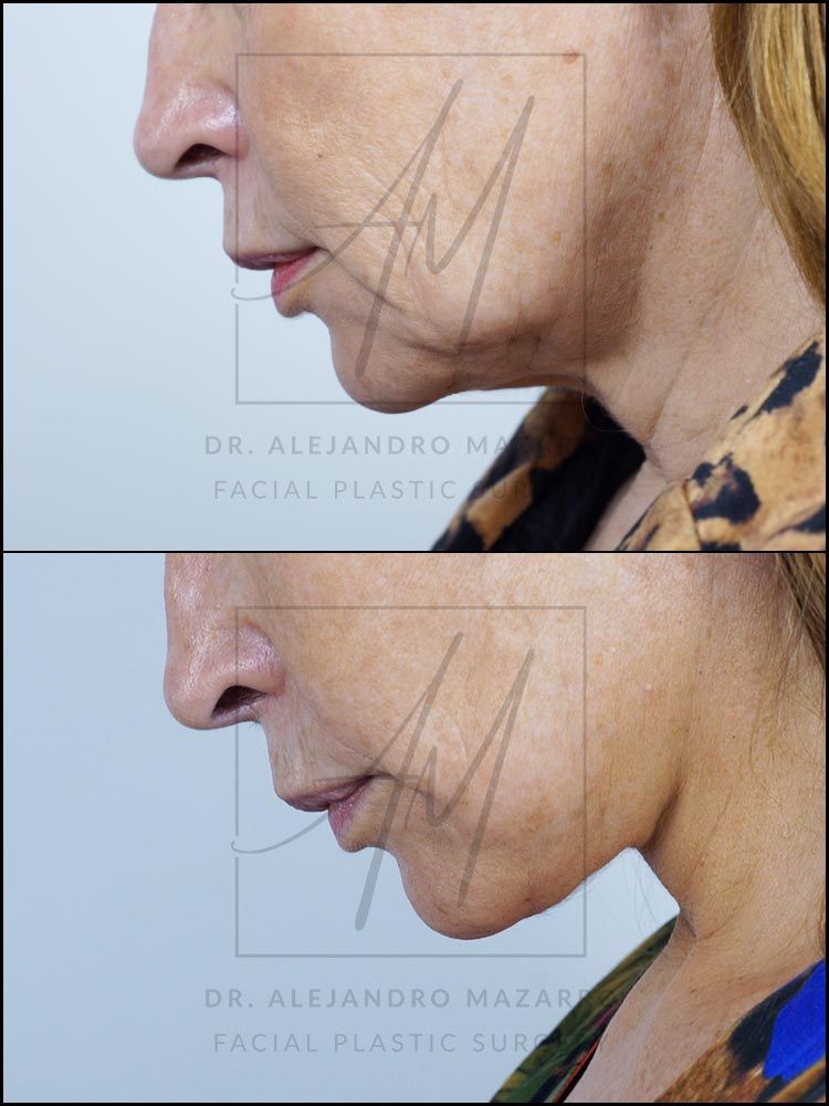 4-month result of preservation deep plane facelift and deep neck lift in a 53-year-old woman, left profile with chin down showing elegant neck and jawline definition. Performed by Dr. Mazarro.