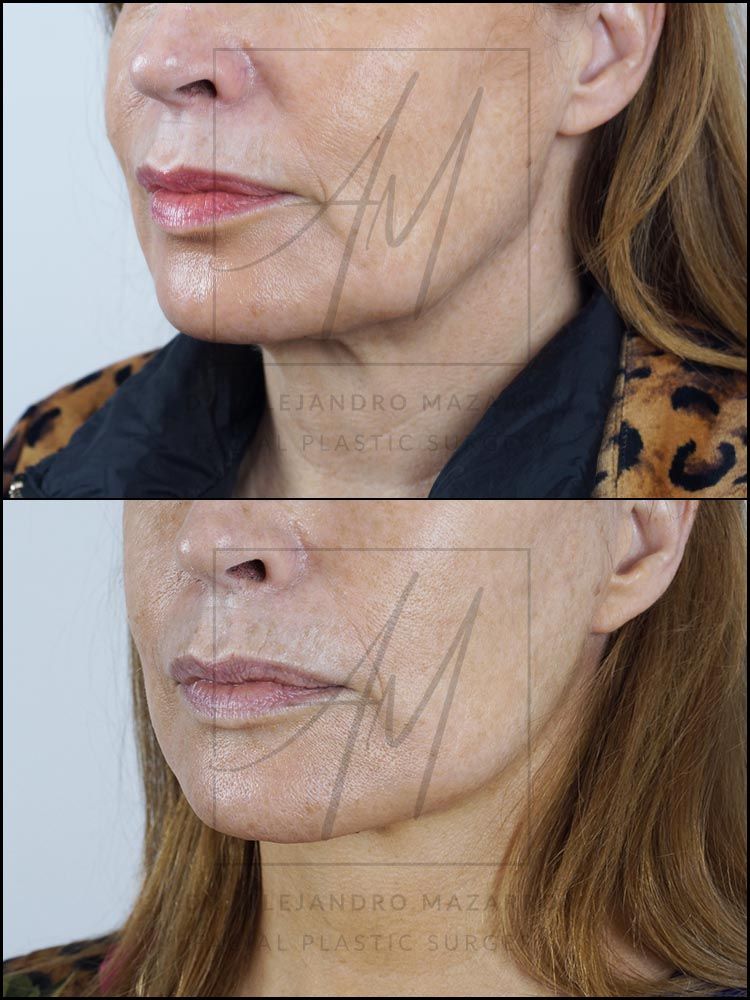 4-month result of preservation deep plane facelift and deep neck lift in a 53-year-old woman, left 3/4 view showing defined jawline and rejuvenated facial oval. Performed by Dr. Mazarro.