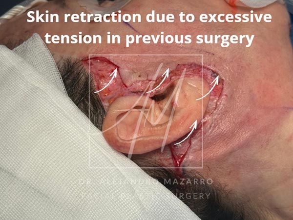 Skin retraction due to excessive tension in previous surgery