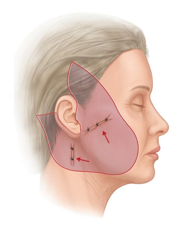 Plicatura de SMAS - Dr. Mazarro