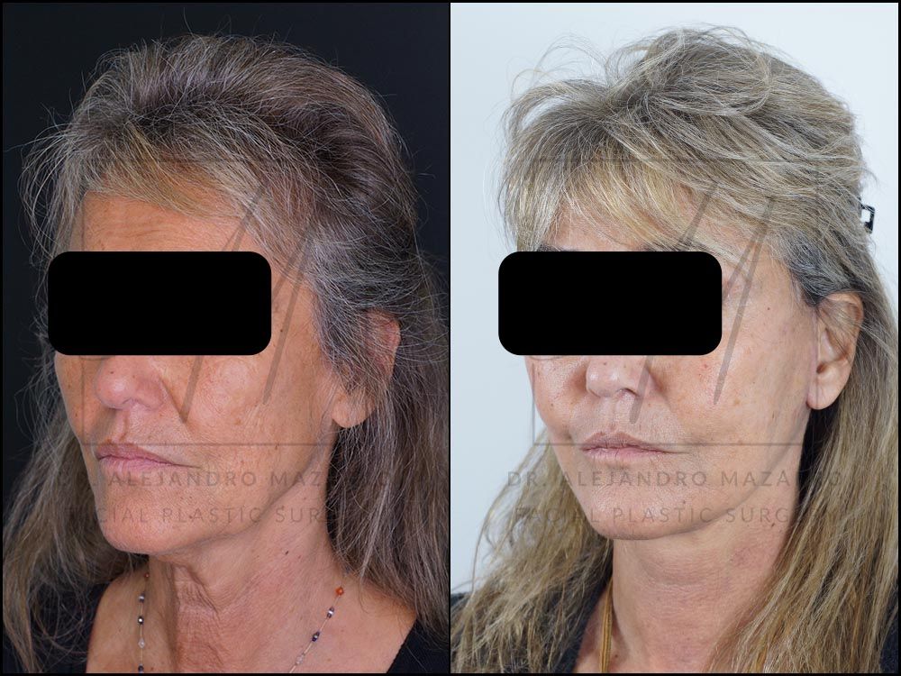 3-week result of a preservation deep plane facelift in a 59-year-old woman, with rejuvenated neck and cervical definition. Performed by Dr. Mazarro.