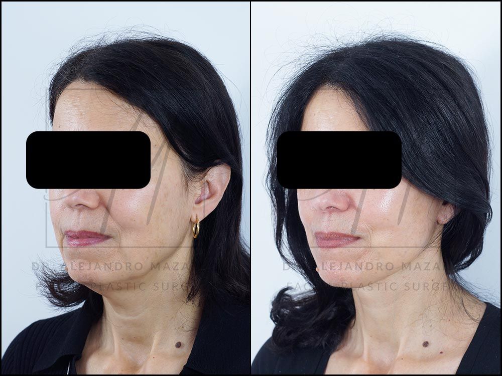Resultado a los 8 meses de lifting deep plane de preservación y deep neck lift en mujer de 56 años, vista 3/4 izquierda con contorno facial definido y cuello rejuvenecido. Realizado por el Dr. Mazarro.
