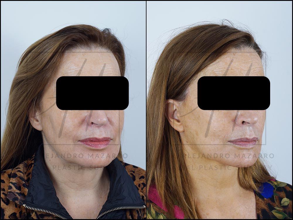 4-month result of preservation deep plane facelift and deep neck lift in a 53-year-old woman, right 3/4 view showing defined jawline and rejuvenated facial oval. Performed by Dr. Mazarro.