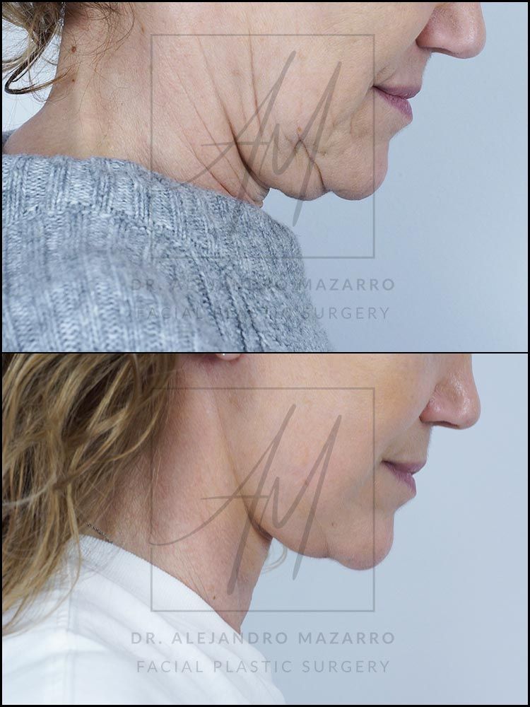 7-week result of preservation facelift in a 55-year-old woman, right profile with chin down showing the definition and naturalness of the rejuvenated neck. Performed by Dr. Mazarro.