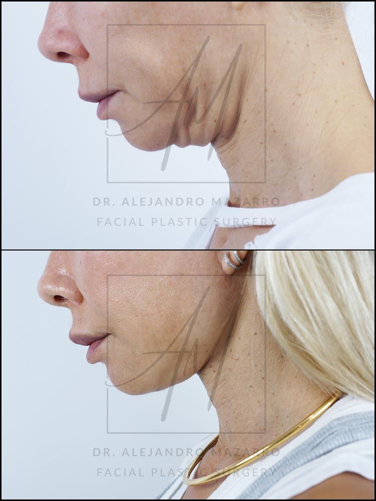 Resultado a los 9 meses de lifting deep plane de preservación y deep neck lift en mujer de 44 años, perfil con mentón hacia abajo mostrando la definición y elegancia del cuello rejuvenecido. Realizado por el Dr. Mazarro.