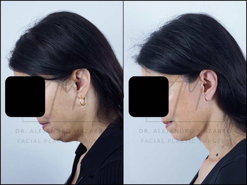 Resultado a los 8 meses de lifting deep plane de preservación y deep neck lift en mujer de 56 años, perfil con mentón hacia abajo mostrando la elegancia y definición del cuello. Realizado por el Dr. Mazarro.