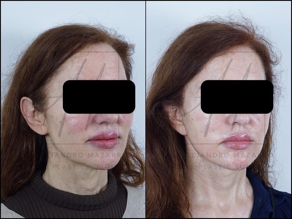 3-month result of preservation deep plane facelift and necklift in a 59-year-old woman, right 3/4 view with rejuvenated facial contour and cervical definition. Performed by Dr. Mazarro.