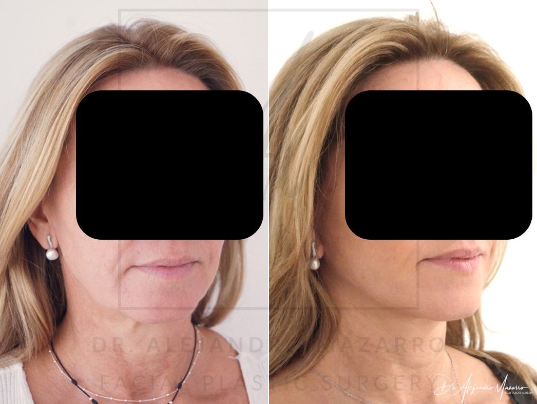 Deep Plane Facelift - Dr. Mazarro