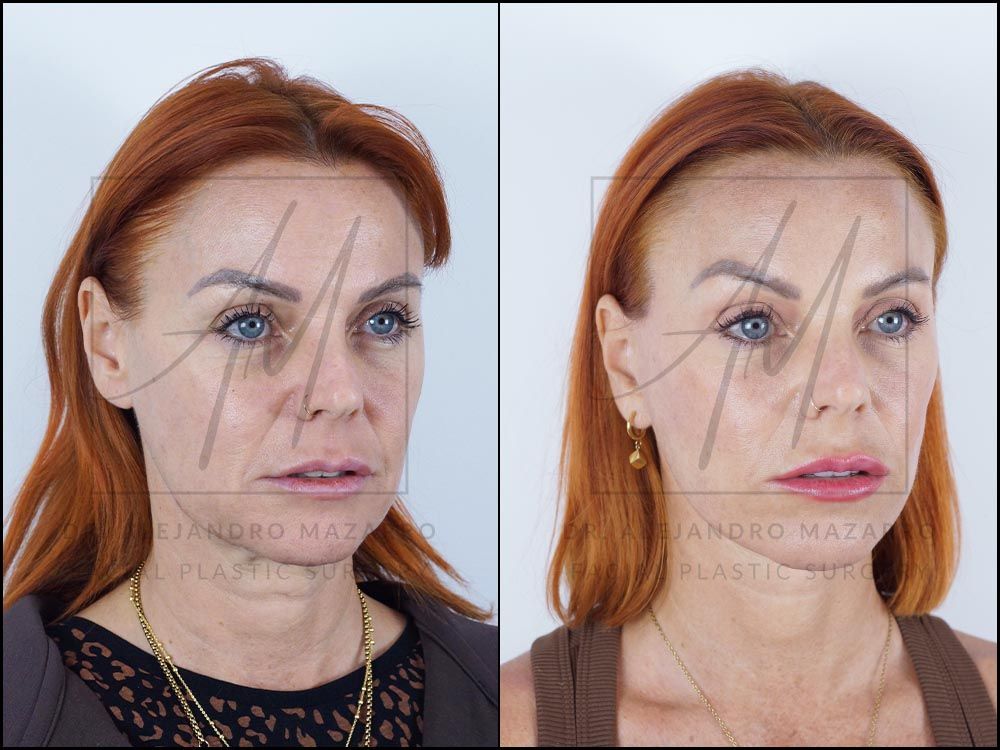 Resultado a los 8 meses de lifting deep plane de preservación en mujer de 47 años, vista 3/4 derecha con contorno facial definido y cuello rejuvenecido. Realizado por el Dr. Mazarro.