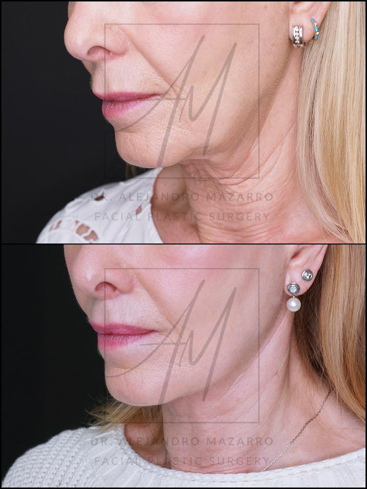 5-month result of preservation deep plane facelift and deep neck lift in a 65-year-old woman, left 3/4 view with chin down showing elegant and natural neck and jawline definition. Performed by Dr. Mazarro.
